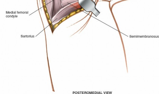 Illustration 83 for Mastering Knee Approaches: Spotlight on Superficial Medial Ligament