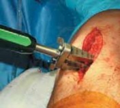 Illustration 32 for Guide Pin Assembly: Key to Flawless Upper Tibial Osteotomy