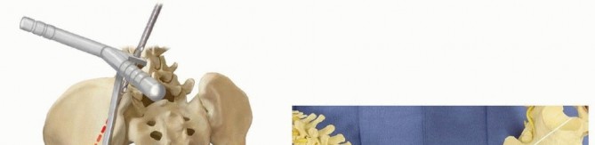 Illustration 12 for Duchenne Muscular Dystrophy: Is Spinal Fusion the Answer?