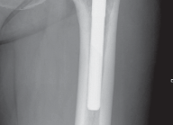 Illustration 31 for The Proxima: Why This Proximally Loading Implant Preserves Bone