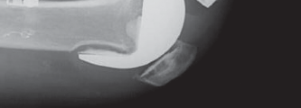 Illustration 7 for Solving Severe Bone Loss: Tantalum for Patellar Reconstruction