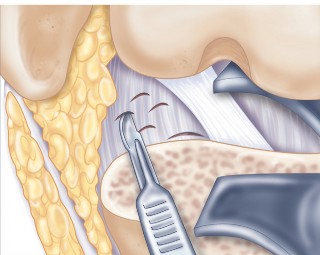 Illustration 36 for Precision Soft Tissue Balancing in Revision: Avoid TKA Pitfalls