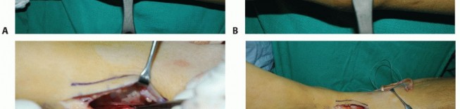 Illustration 45 for Restore Movement: Tendon Transfer for Common Peroneal Nerve Foot Drop