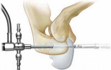 Illustration 29 for Capsular Releases for Loss of Motion: Restore Your Shoulder