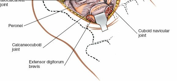 Illustration 114 for Optimized Approaches to the Dorsum of the Foot & Ankle