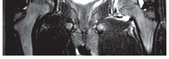 Illustration 6 for Labral Support Shelf Procedure: Preventing Perthes Deformity