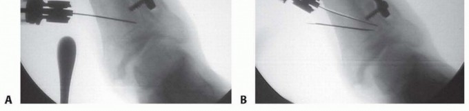Illustration 7 for Distal Tibial Osteotomy: Fixing Varus & Valgus Ankle Alignment