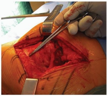 Illustration 8 for Extended Trochanteric Osteotomy: How et al Extended Revision THA Solutions