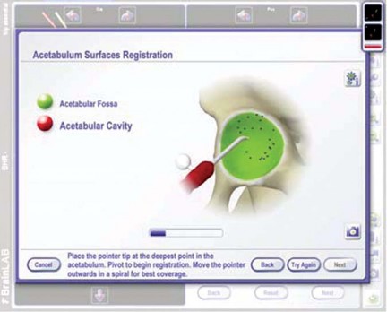 Illustration 24 for Minimizing Risks: Computer Navigation in Hip Resurfacing Arthroplasty