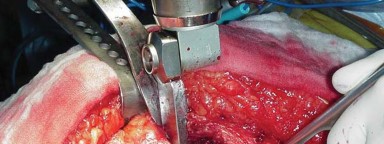 Illustration 18 for THA for patients with proximal femoral deformity: Practical solutions