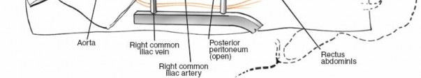 Illustration 75 for Approach to the Lumbar Spine: Mastering Techniques & Anatomy