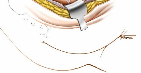 Illustration 24 for Acetabulum Posterior Approach: Simplest Fix for Hip Fractures