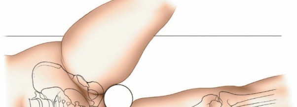 Illustration 62 for Optimal Femoral Approaches: Mastering the Lateral Intermuscular Septum