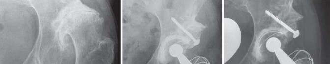 Illustration 33 for Expert Bone Grafting for Primary Total Hip Replacement Success