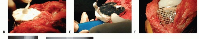 Illustration 10 for Bone Loss Bone Grafting for Challenging Tibial Defects