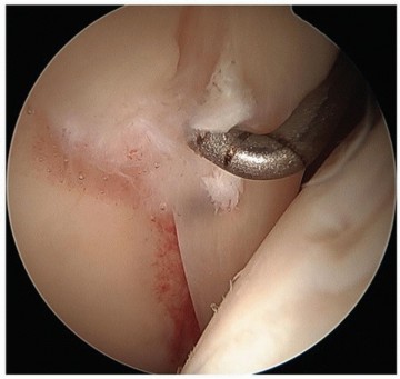 Illustration 3 for Hip Pain Relief: Arthroscopy for Nonstructural Pathology