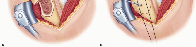 Illustration 8 for Optimizing Fixation of Proximal Humerus Fractures: A Guide
