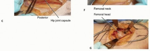 Illustration 17 for Is a Sliding Hip Screw Best for Your Femoral Neck Fracture?