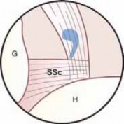 Illustration 6 for Arthroscopic Subscapularis Repair: The lo iky brady Method for Stability