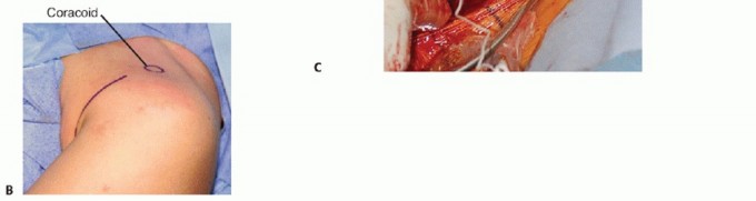 Illustration 3 for Surgical Approaches to Shoulder & Elbow: Pearls and Pitfalls
