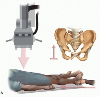 Illustration 5 for Emergency Fixation of the Pelvis: Control Bleeding & Restore Stability