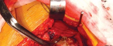 Illustration 12 for Posterolateral Surgical Approaches: Achieve Optimal Hip Replacement