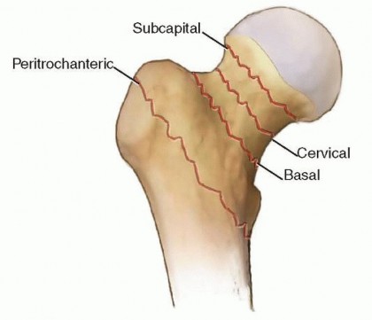 Illustration 2 for Hemiarthroplasty of the Hip: Indications & Types Explained