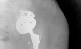 Illustration 6 for How We Tackled Massive Bone Loss in a Revision Hip Arthroplasty