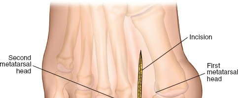 Illustration 205 for Optimized Approaches to the Dorsum of the Foot & Ankle