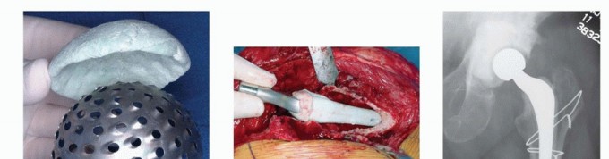 Illustration 10 for Resection Arthroplasty & Spacers: Optimizing Time of Reimplantation
