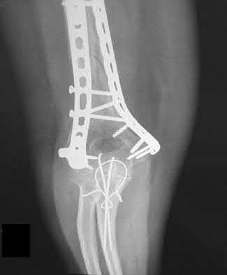 Illustration 79 for OrthoCash: Trauma MCQs & Cases for a yearold woman
