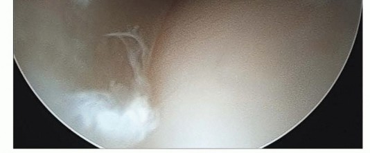 Illustration 4 for Hip Arthroscopy: Your Minimally Invasive Solution for Hip Pain