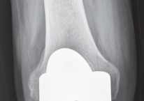 صورة طبية: استبدال مفصل الركبة بالحد الأدنى من التدخل الجراحي: ألم أقل وتعافٍ أسرع مع النهج شبه الرضفي الإنسي