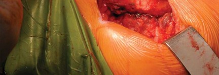 Illustration 59 for Kinectiv® Stem: Modular Necks for Primary THA Success