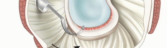 Illustration 22 for Regain Stability: Arthroscopy for Anterior Instability & the Inferior Glenohumeral Ligament