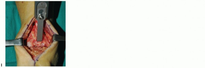 Illustration 6 for Optimize Pain Management with Proximal Ring Block for Ankle Arthrodesis