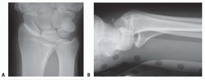 Illustration 24 for Fragment-Specific Fixation: Restore Carpal Facet Horizon