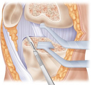 Illustration 40 for Mastering Valgus Total Knee Replacement: Techniques & Pitfalls