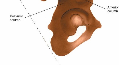 Illustration 3 for Pelvis & Acetabulum Approaches: Unlocking the Posterior Superior Iliac