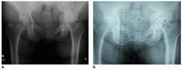 Illustration 3 for Mastering The Uncemented Socket: Ensure Lasting Hip Fixation