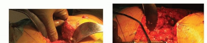 Illustration 3 for Overcoming Proximal Femoral Bone Loss: Fluted Stems in Revision THA