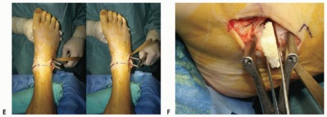 Illustration 55 for Medial Ankle Instability: Find Relief with Reconstruction