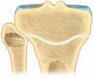 Illustration 15 for Percutaneous Epiphysiodesis: Precisely Closing the Third of the Physis