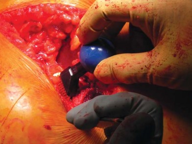 Illustration 40 for Unlock better THA: The technique of short stem for less invasiveness