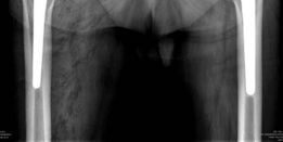 Illustration 6 for Revision THA Acetabulum: Overcoming Paprosky IIIA & Metallosis