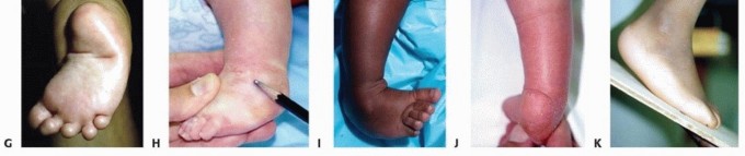 Illustration 4 for Resistant Clubfoot Solved: Posteromedial and Posterolateral Release