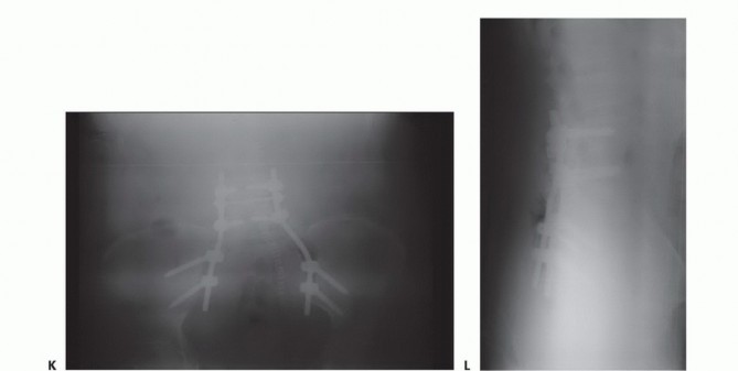 Illustration 56 for Sacral Tumor Surgery: Safeguarding Bowel & Bladder Control