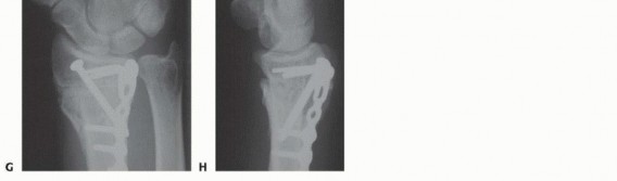 Illustration 20 for Precision Correction for Distal Radius Malunion