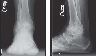 Ankle Arthritis Case: Easing Painful Plantar Flexion Hindfoot