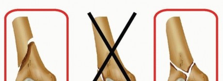 Illustration 9 for Retrograde Femoral Nailing: Optimizing Surgical Outcomes